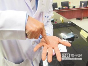 周文程醫師用手指出的手掌與手指交接部分，是「扳機指」患者容易有塊狀突出物的地方。（邱文秀攝）