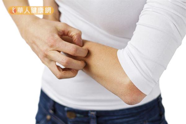冬季癢又稱為「冬季濕疹」或「缺脂性皮膚炎」，多發生於四肢部位。