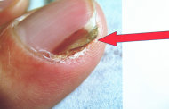 醫師表示，甲板下鱗狀細胞癌除會有指甲增厚、變形等類似黴菌感染造成的「灰指甲」症狀外，指甲邊緣也可能出現「線狀黑甲、紅甲」情形。（photo by台北榮總）