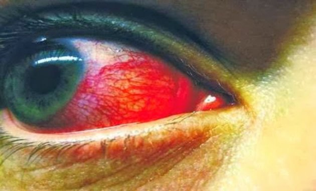 ΔΕΙΤΕ 5 ΣΟΒΑΡΕΣ ασθένειες που φαίνονται στα μάτια μας!