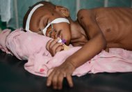 (20 mai) Criança desnutrida, em um hospital de Mogadíscio