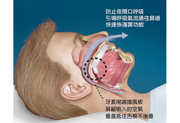 避免夜間以嘴巴呼吸，自然引道呼吸氣流通往鼻道，並恢復鼻部本身功能，避免發生「用盡廢退」的情況。