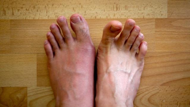 foods that cause gout