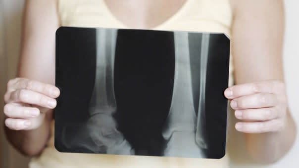 Resultado de imagen de uñas osteoporosis getty