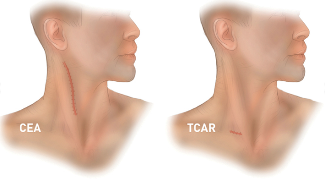 Two illustrated human heads and necks with neck scars. CEA scar is big, TCAR scar is small.